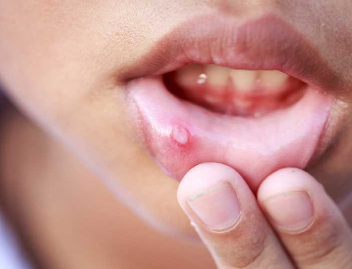 درمان آفت دهان با جوش شیرین